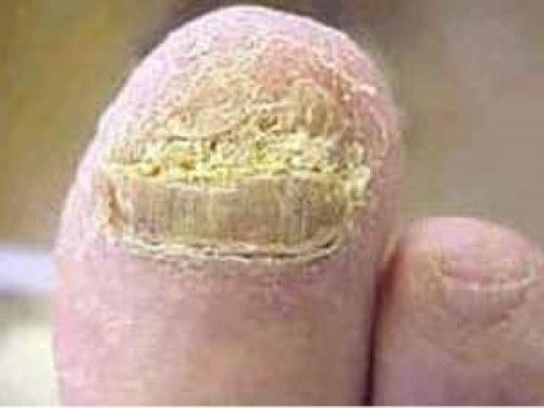 Эффективное народное средство от грибка ногтей. Лечение грибка ногтей отзывы о народных средствах