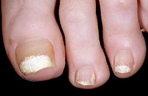 Белые ногти на ногах больших пальцев причина. Причины «побеления» ногтевой пластины