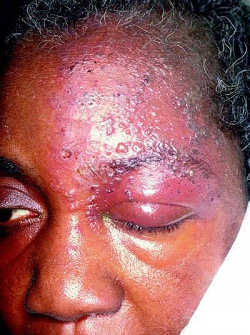 Воспаление тройничного лицевого нерва. Причины невралгии тройничного нерва 02