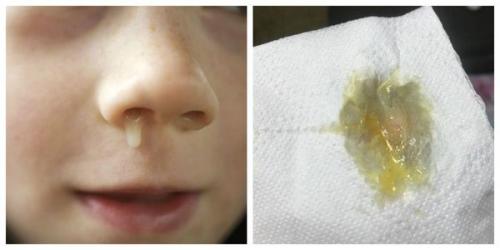 Заложенность носа с насморком. Причины появления насморка 07