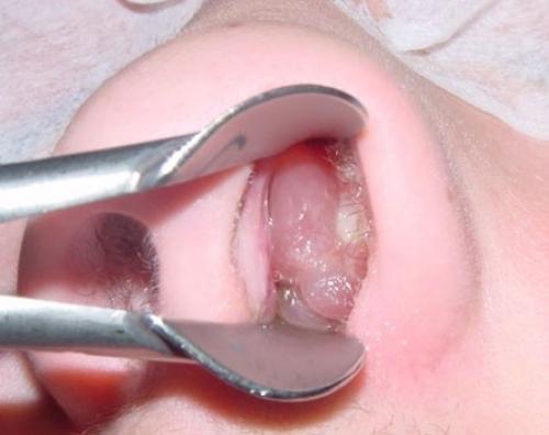 Затяжной насморк у взрослого форум. Хронический ринит