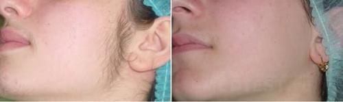 Выпадение волос после лазерной эпиляции.  Отличия лазерной эпиляции от фотоэпиляции и других видов эпиляции? 04