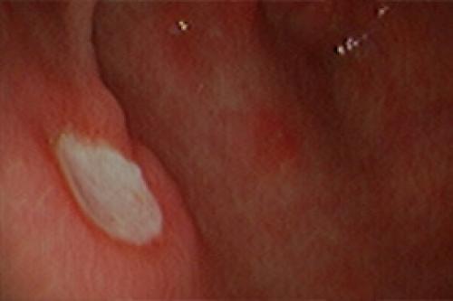 Методы диагностики Helicobacter pylori. Показания и методы исследования больных на Helicobacter pylori 02