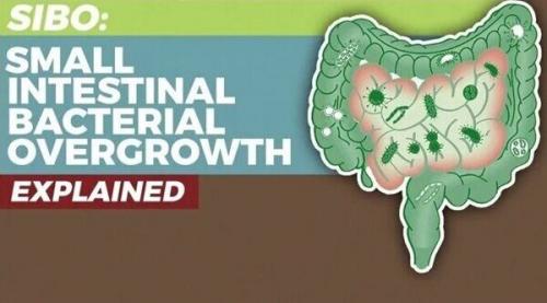Избыточный бактериальный рост в тонкой кишке. Small Bowel Bacterial Overgrowth Syndrome: Diagnosis And Treatment 02