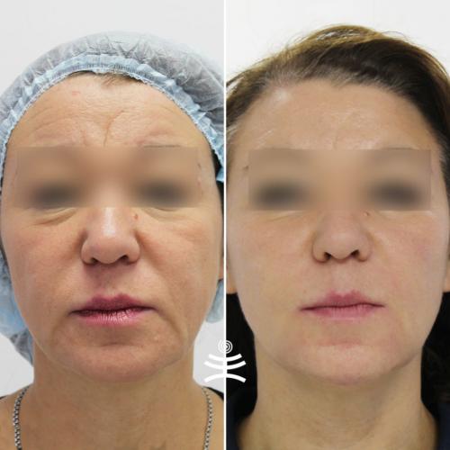 Можно ли использовать контурную пластику или другие аппаратные методы для подтяжки лица. Аппаратные процедуры