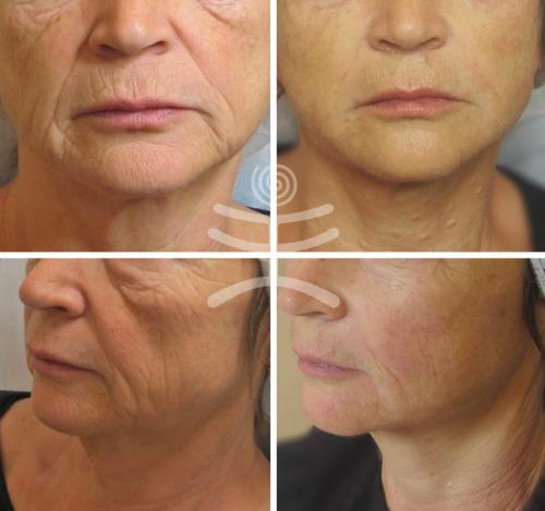 Можно ли использовать контурную пластику или другие аппаратные методы для подтяжки лица. Аппаратные процедуры