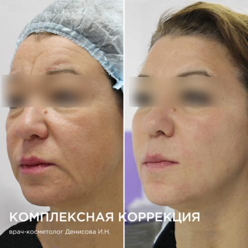 Можно ли использовать контурную пластику или другие аппаратные методы для подтяжки лица. Аппаратные процедуры