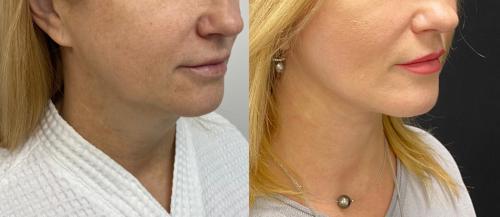 Какие причины появления брылей и бульдожьих щек. Как убрать брыли и подтянуть овал лица?