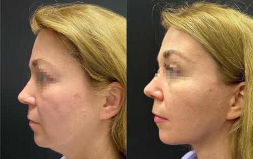 Какие долгосрочные методы удаления брылей на лице существуют, и как они работают. Как убрать брыли и подтянуть овал лица?