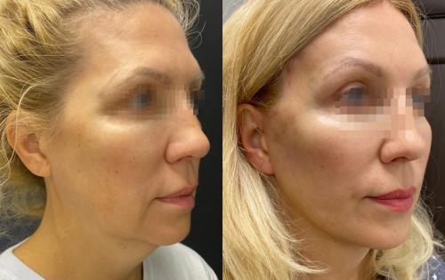 Какие причины появления брылей и бульдожьих щек. Как убрать брыли и подтянуть овал лица?