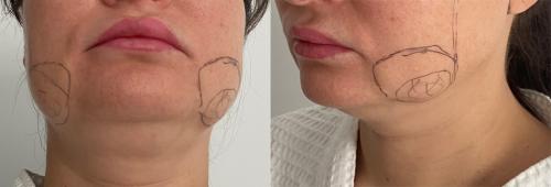 Как правильно ухаживать за кожей после удаления брыли. Как убрать брыли и подтянуть овал лица?