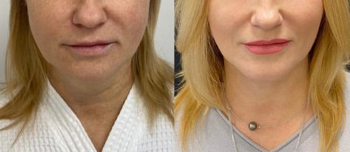 Какие причины появления брылей и бульдожьих щек. Как убрать брыли и подтянуть овал лица?