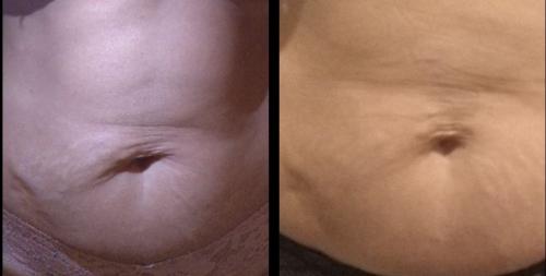 Эффективно и безопасно: как убрать брыли в 2025 году с помощью тейпов 01 Эффективно и безопасно: как убрать брыли в 2025 году с помощью тейпов 01