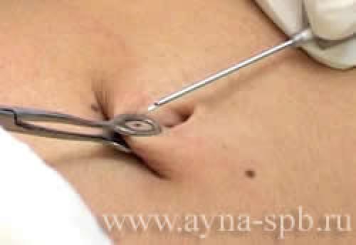 Когда безопасно менять кольцо на пупке в первый раз. Прокол пупка: тонкости и особенности 02 Когда безопасно менять кольцо на пупке в первый раз. Прокол пупка: тонкости и особенности 02