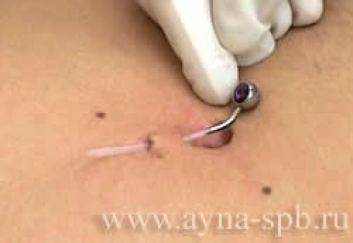 Как правильно заживить пирсинг пупка. Пирсинг пупка 03