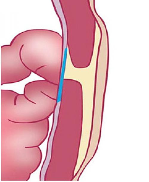Операция по удалению пупочной грыжи. Устранение пупочной грыжи 03