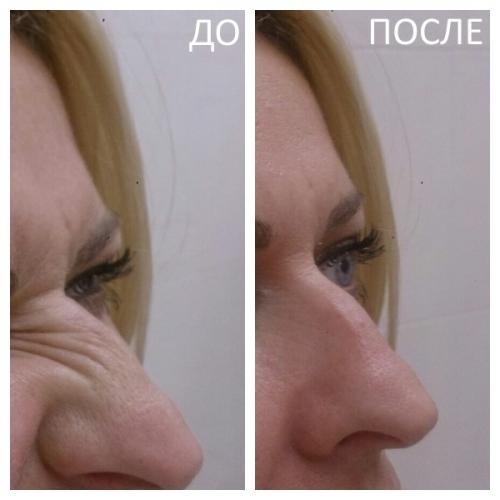 Сколько единиц ботокса уходит на лоб и межбровку и глаза. Сколько сеансов требуется? 03