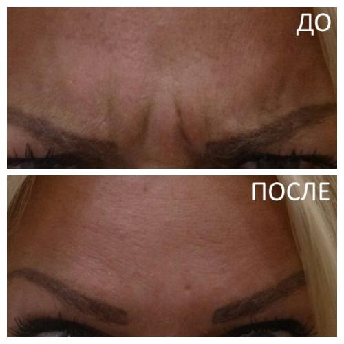 Сколько единиц ботокса уходит на лоб и межбровку и глаза. Сколько сеансов требуется? 01