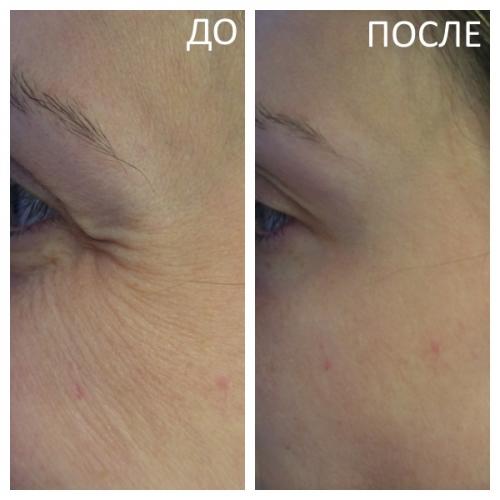 Сколько единиц ботокса уходит на лоб и межбровку и глаза. Сколько сеансов требуется? 02