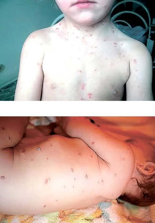 Жжение зуд и покалывание во всем теле: причины и способы борьбы 04