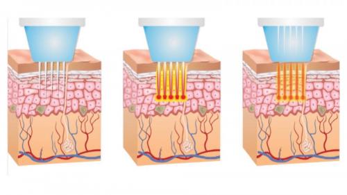 Массаж от отеков лица утром. Как избавиться от отеков на лице 03