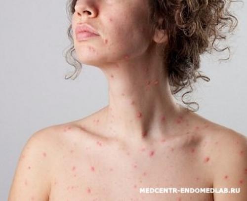 Тест на непереносимость гистамина. Гистаминоз: общая оценка патологии, симптомы и причины развития