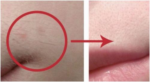 Как убрать пушок или усики над верхней губой. Почему у женщины появляются усики 01 Как убрать пушок или усики над верхней губой. Почему у женщины появляются усики 01