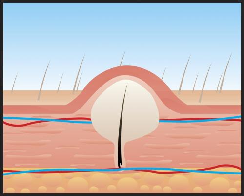 Мазь от вросших волос в зоне бикини. Вросшие волосы в паху