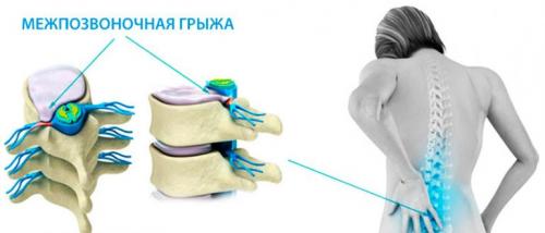 Отжимания на брусьях польза и вред. Польза от выполнения упражнения 17