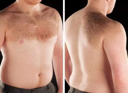 Как избавиться от пигментных пятен. Симптомы гиперпигментации кожи 02