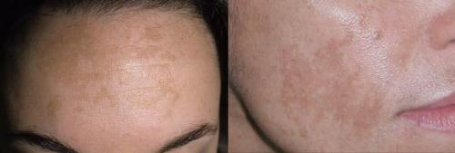 Как избавиться от пигментных пятен. Симптомы гиперпигментации кожи 10