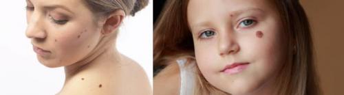 Как избавиться от пигментных пятен. Симптомы гиперпигментации кожи 12