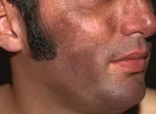 Как избавиться от пигментных пятен. Симптомы гиперпигментации кожи 07