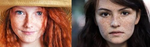 Как избавиться от пигментных пятен. Симптомы гиперпигментации кожи 13