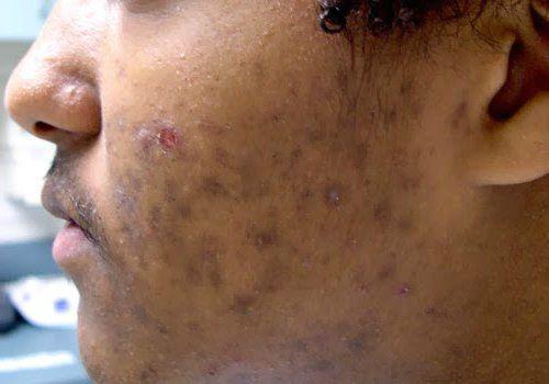 Как избавиться от пигментных пятен. Симптомы гиперпигментации кожи 03