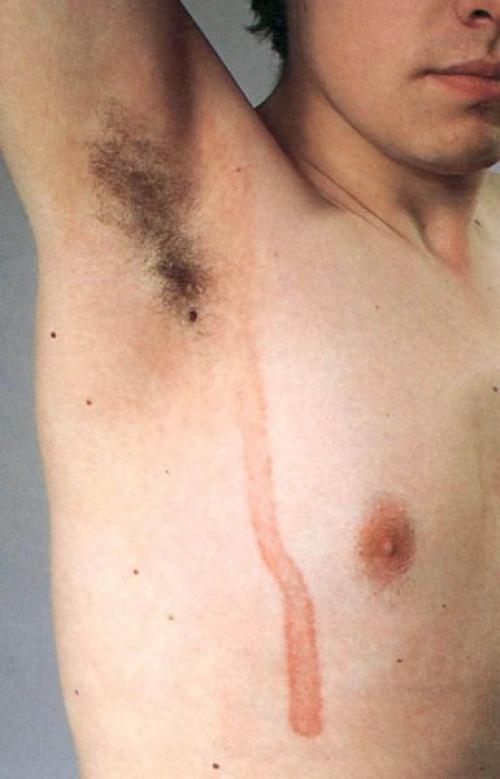 Как избавиться от пигментных пятен. Симптомы гиперпигментации кожи 04