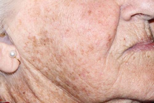 Как избавиться от пигментных пятен. Симптомы гиперпигментации кожи 05