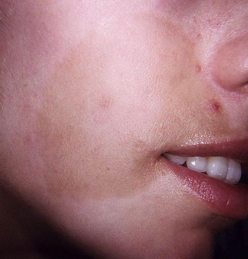 Как избавиться от пигментных пятен. Симптомы гиперпигментации кожи 06