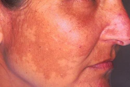 Как избавиться от пигментных пятен. Симптомы гиперпигментации кожи 01