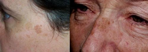 Как избавиться от пигментных пятен. Симптомы гиперпигментации кожи 11