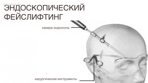 Подтяжка лица после 50 лет: как вернуть молодость без операции 08