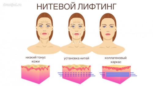 Подтяжка лица после 50 лет: как вернуть молодость без операции 06