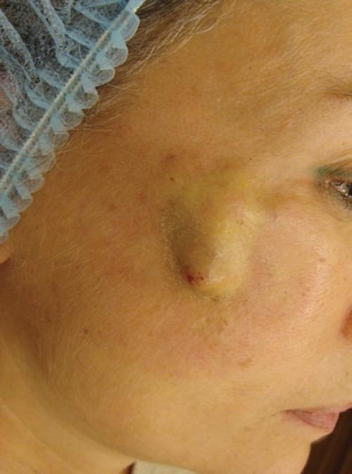 Остеоинтеграция игл: новый способ улучшения внешнего вида 07 Остеоинтеграция игл: новый способ улучшения внешнего вида 07