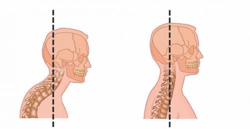 Как убрать вдовий горд. Как убрать вдовий горб? 01