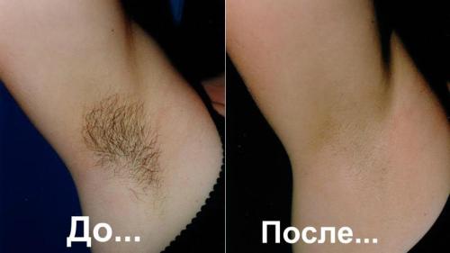 Как избавиться от усиков. О чем молчат девушки? Как избавиться от усиков? 02 Как избавиться от усиков. О чем молчат девушки? Как избавиться от усиков? 02