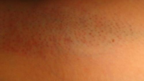 Ответы на популярные вопросы по лазерной эпиляции. Да всю правду доложи. Отвечаем на популярные вопросы о лазерной эпиляции 12