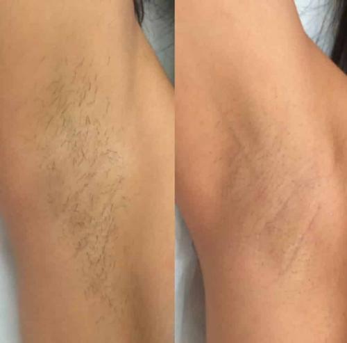 Как подготовиться к лазерной эпиляции подмышек. Показания и противопоказания