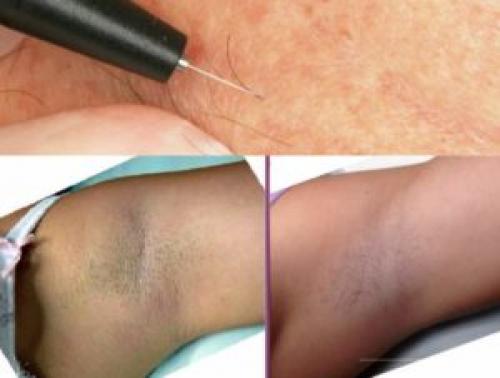 Электроэпиляция цены. Электроэпиляция сколько стоит? Сколько нужно сеансов и процедур для полного удаления волос, сколько заживает, цены +Фото