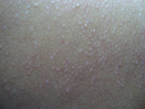 Что лучше лазерная или электроэпиляция. Лазерная эпиляция 01