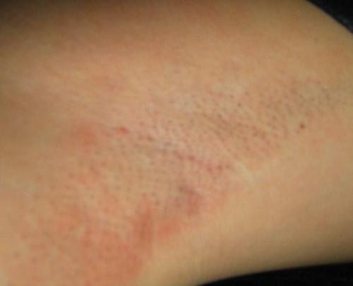 Ответы на вопросы по лазерной эпиляции. Как работает лазерная эпиляция? 14